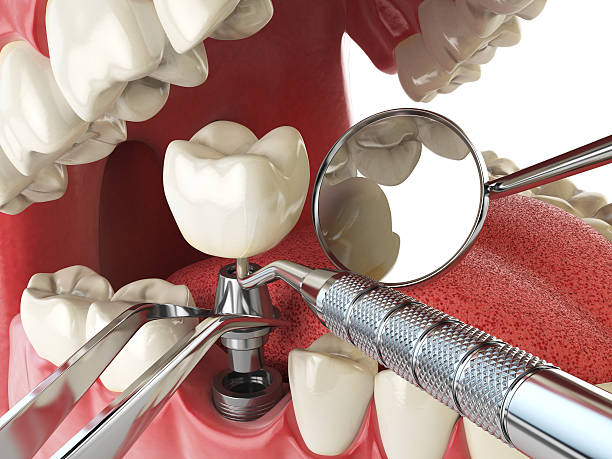 Best Emergency Broken Tooth Repair in Vienna, IL